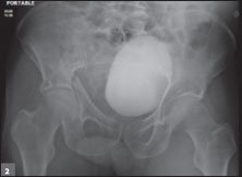 AP pelvis radiograph