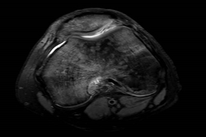 MRI of MPFL reconstruction