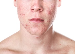 Young Man With Acne