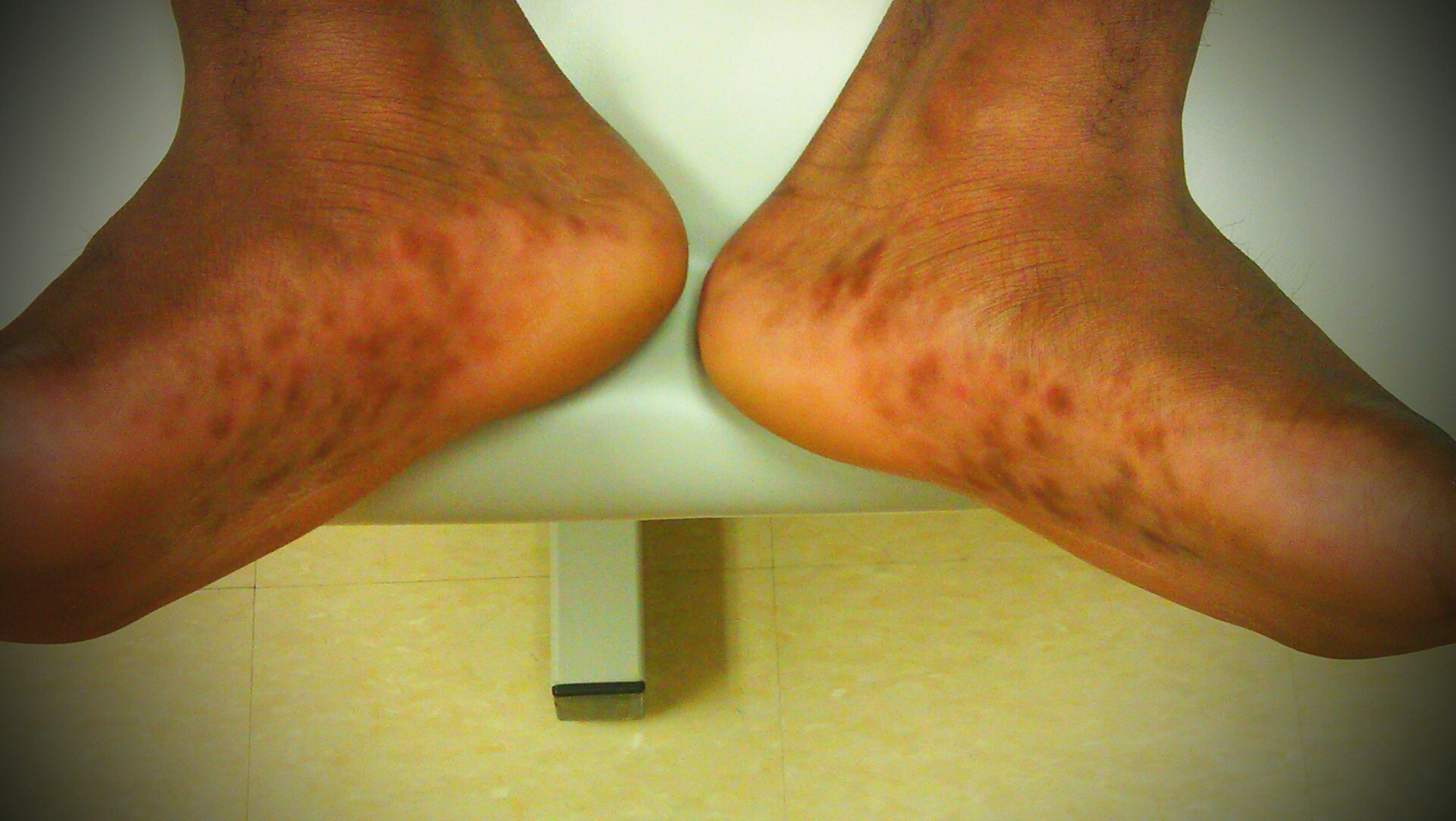 case-a-16-year-old-male-complains-of-a-rash-on-both-hands-and-feet