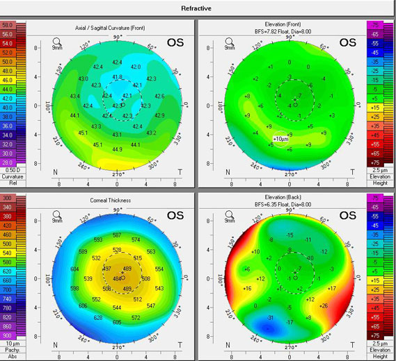 BLOG: Evaluation for keratoconus crucial for presurgical patients