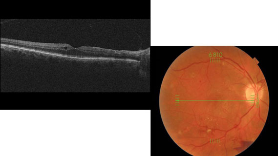 oct macular test