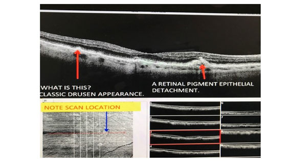 Retinal pigment epithelium detachment