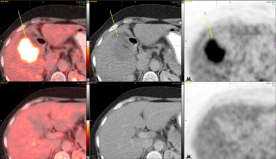 Figure 2. Interval development of a heterogeneously FDG–avid hypodense lesion involving segments 4B and 5 of the liver (SUVmax, 16), highly concerning for metastatic disease.