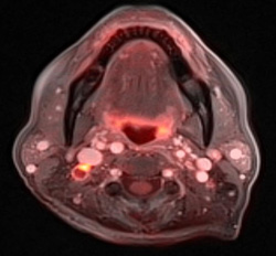 Figure 3: Fused image with PET and postcontrast axial GRASP shows a right level IIb necrotic metastatic lymph node.