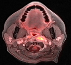  Figure 4: Fused image with PET and postcontrast axial GRASP shows a left retropharyngeal metabolically active metastatic lymph node.