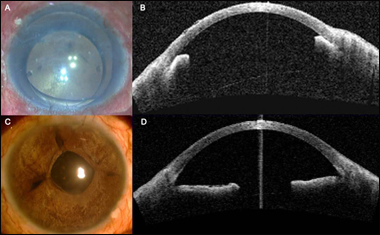 SFT for secondary angle-closure glaucoma