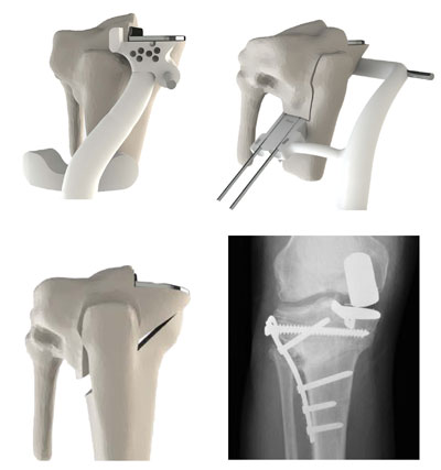 3D knee surgery