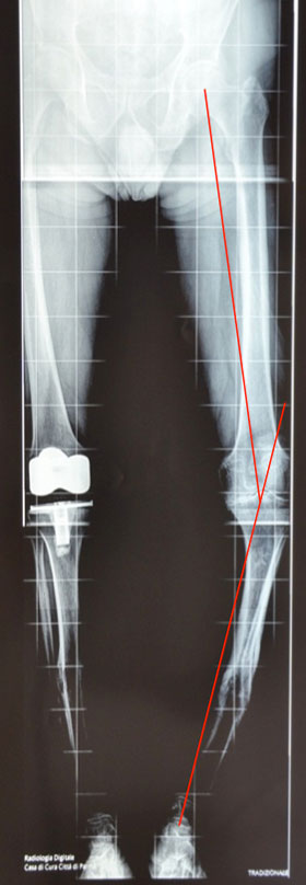 Knee deformity