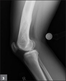 Postoperative result of distal femoral osteotomy