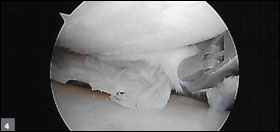 Pie crusting is shown with valgus stress applied.