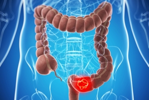 Illustration of colon cancer